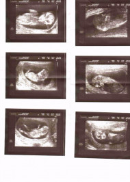 Фото УЗИ на 16 неделе беременности