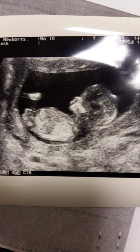 14 недель мальчик. 14 Недель беременности УЗИ скрининг. УЗИ 14 недель беременности. Снимок УЗИ 13 недель беременности мальчик. УЗИ 13-14 недель беременности мальчик.
