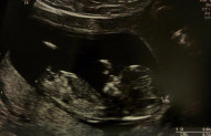 Фото УЗИ на 13 неделе беременности