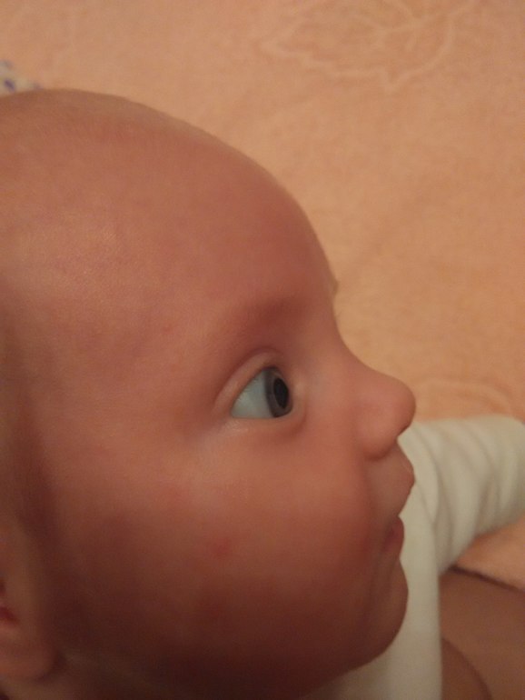 Белки глаз новорожденного. Желтые склеры глаз у новорожденных. Глаза новорожденного при желтухе. Желтые белки у новорожденных. Глаза у новорожденного при желтушке.