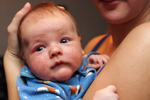 Аллергические реакции в 2 месяца