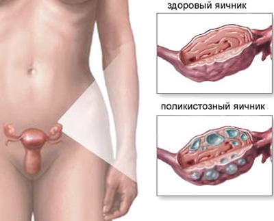 Поликистоз ???
