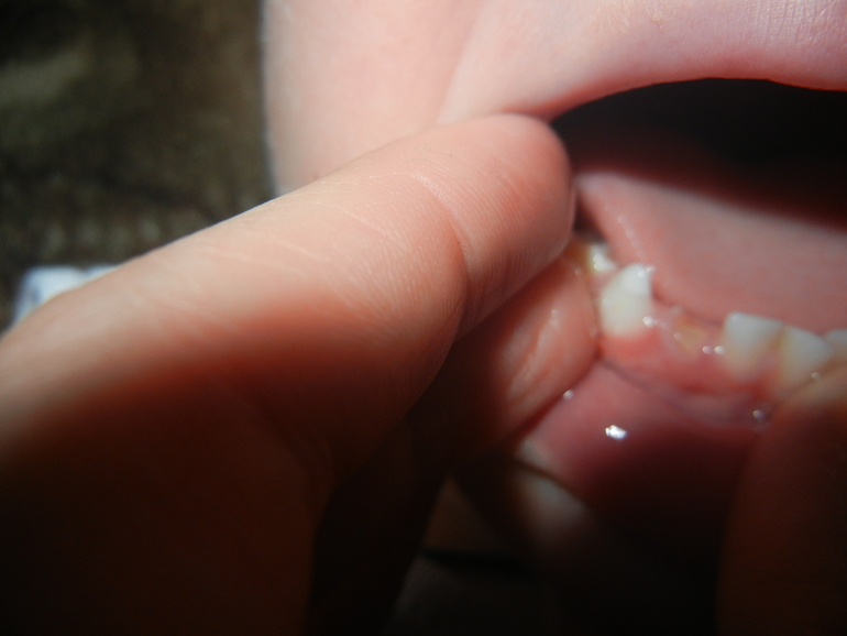 соэ 36. из-за зуба??