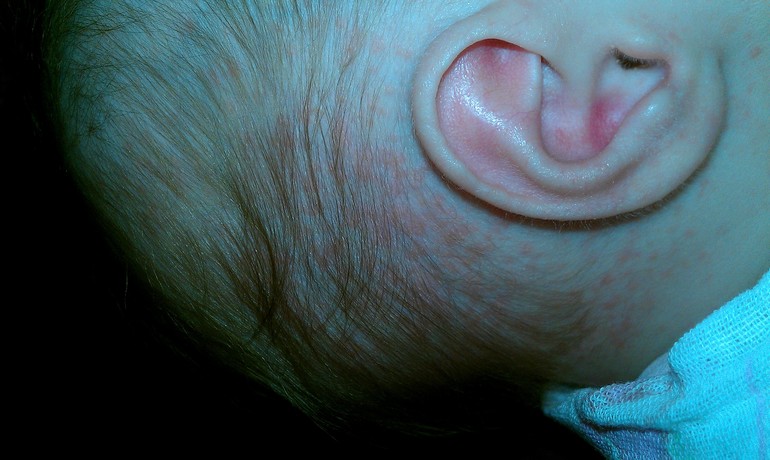 Аллергия на хлеб?