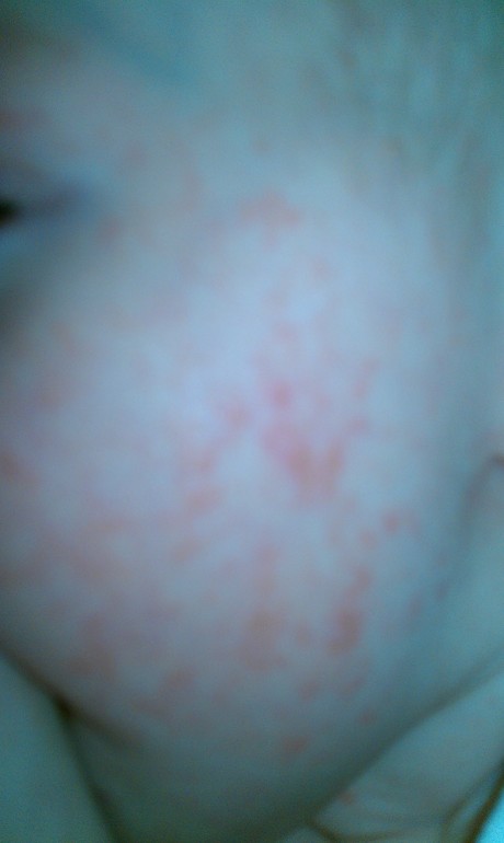 Аллергия на хлеб?