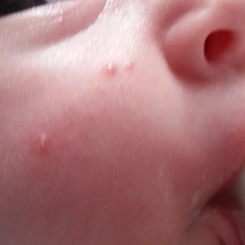 аллергия или ветрянка?