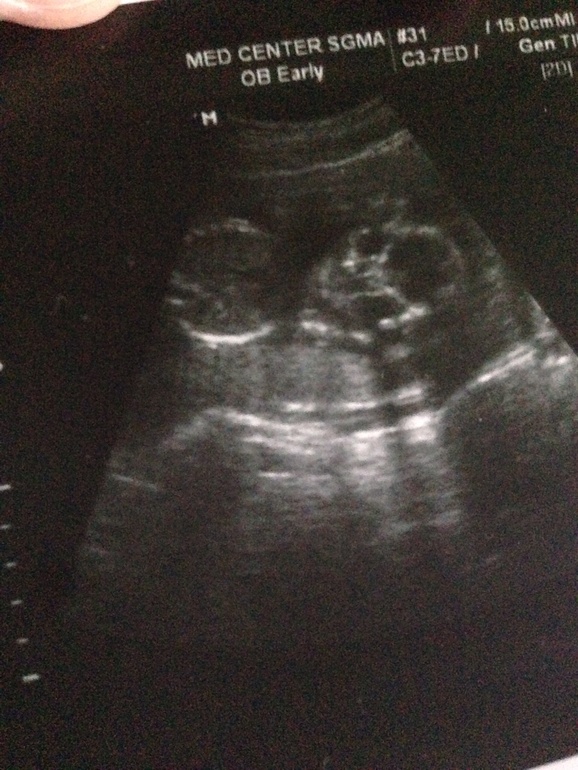 Вот и 2ой скриннинг мы прошли успешно))