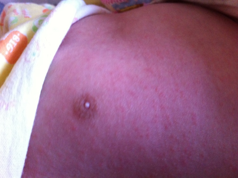 Выделения из груди малышки!прошу мнения