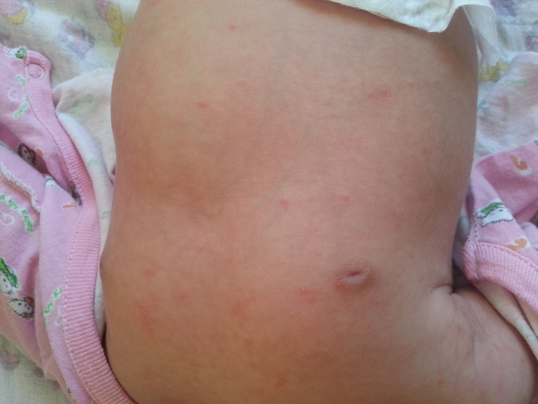 Красные пятна на теле