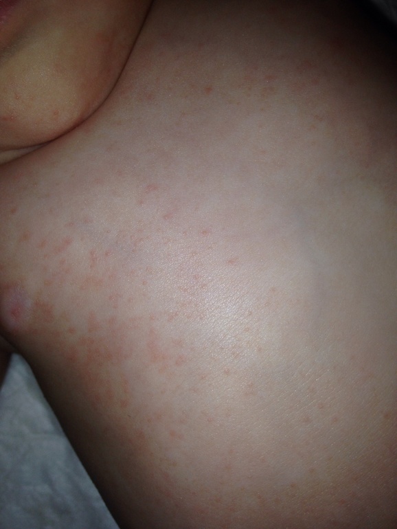 Помогите разобраться: потничка или аллергия?