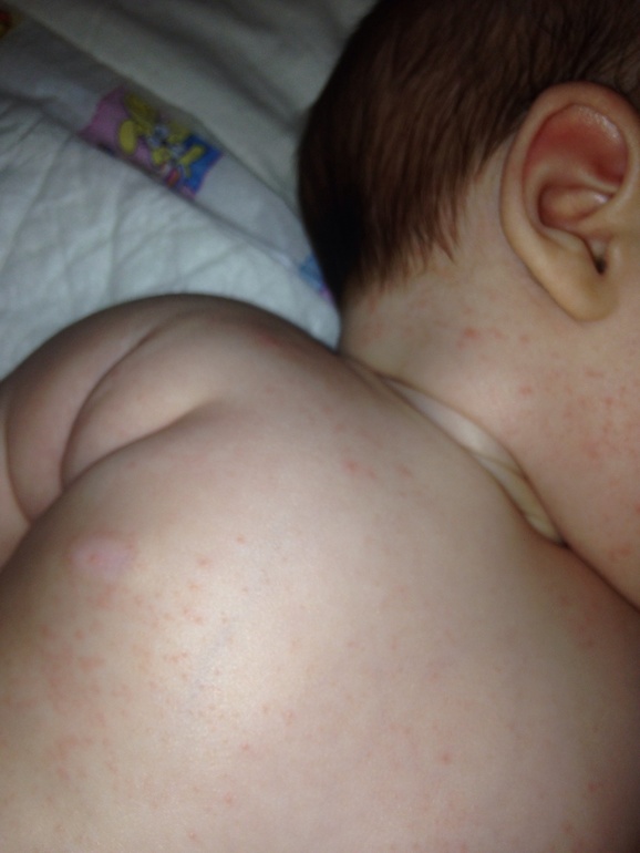 Помогите разобраться: потничка или аллергия?