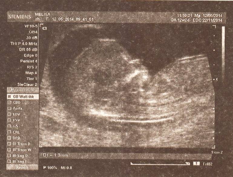 13 неделя. УЗИ!