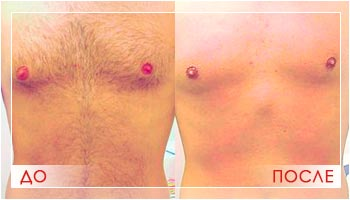 Элос эпиляция в Днепропетровске