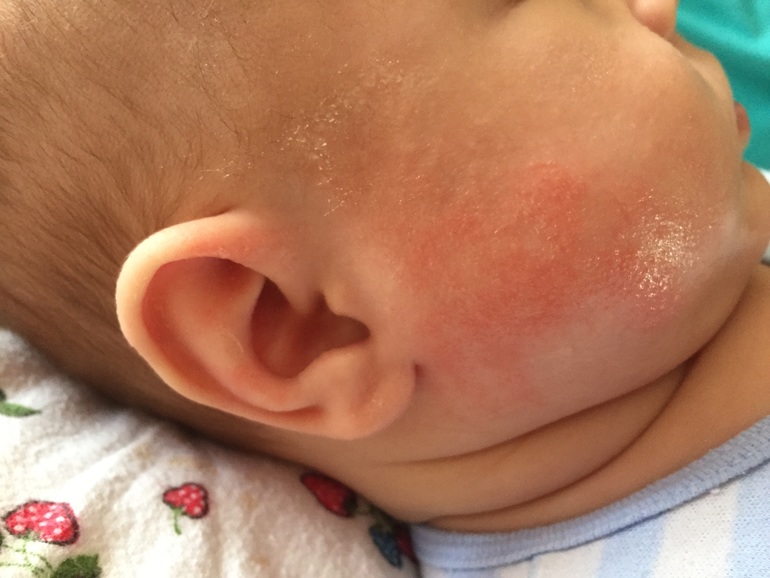 Аллергия на эмолиум у ребенка thumbnail