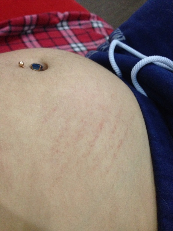 Девочки, милые, подскажите, может знает кто что на животике такое?