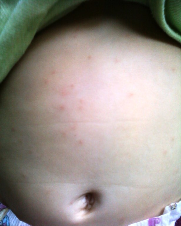 Что за сыпь