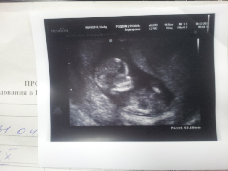 наш малыш 12 недель,говорят что похоже это дочь