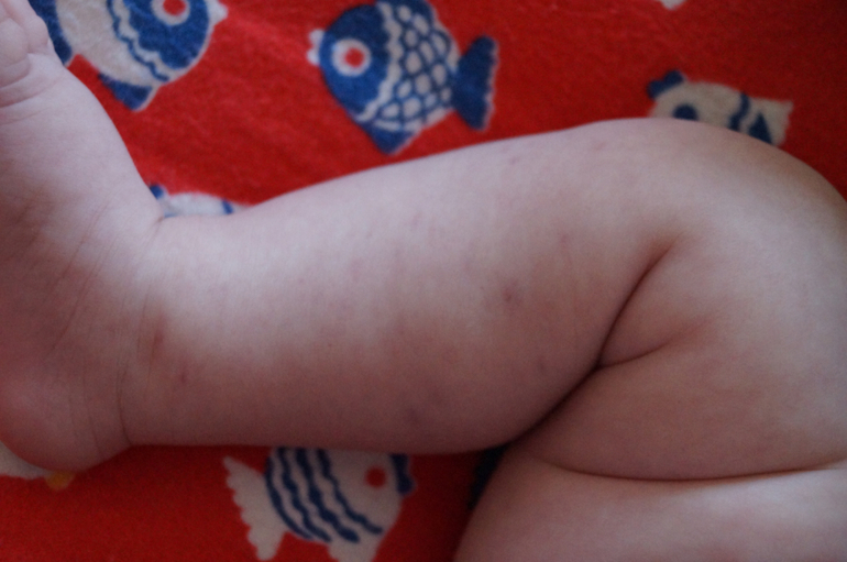 пятна на ножках