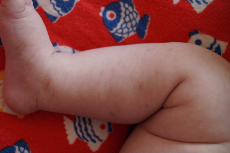 пятна на ножках