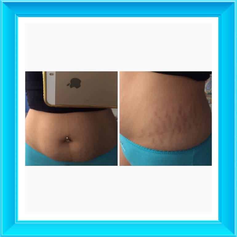 Вопрос о мезороллере ...