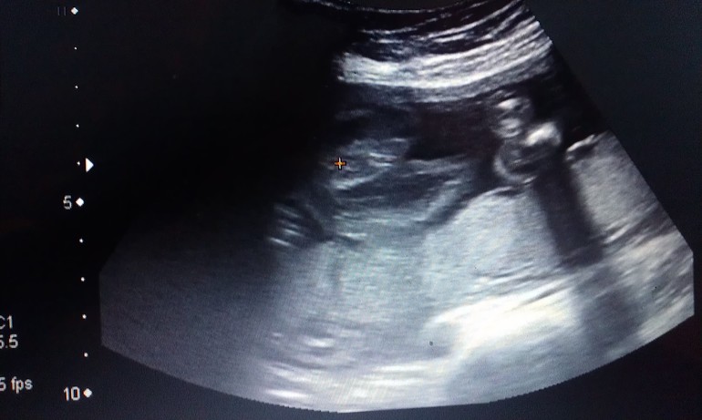 узи,пол ребенка и возможные ошибки