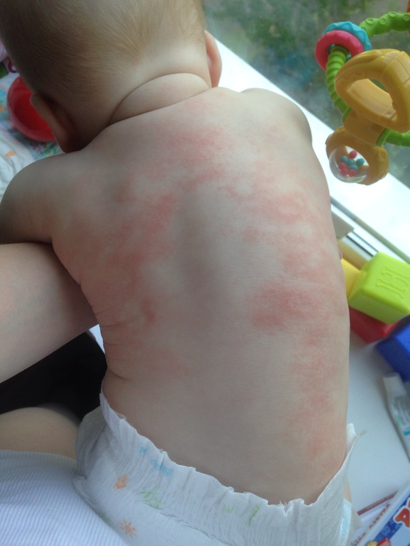 Аллергия или потница?