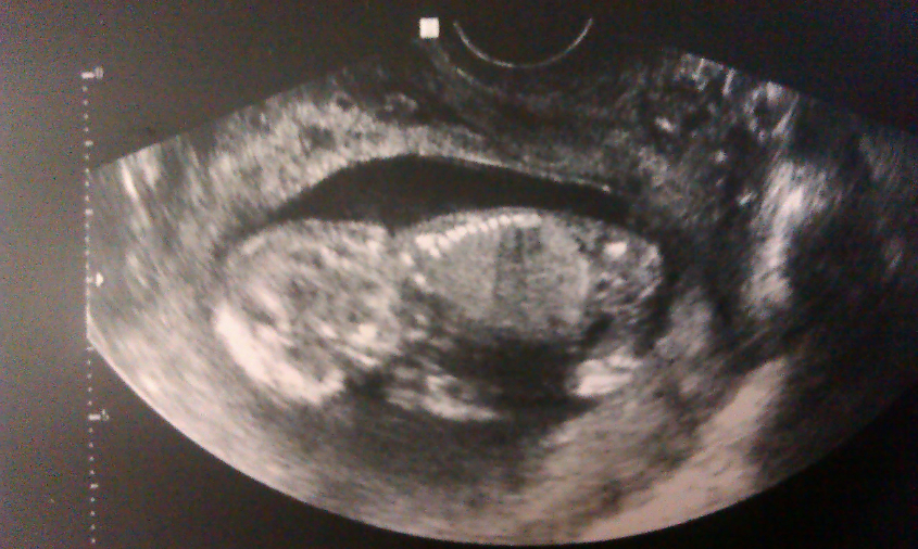 Первый скрининг или наша 13 неделя радости!