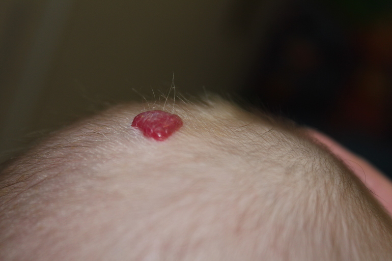 гемонгиома