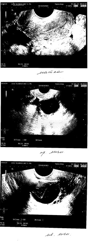 Результаты УЗИ, я в некотором шоке.