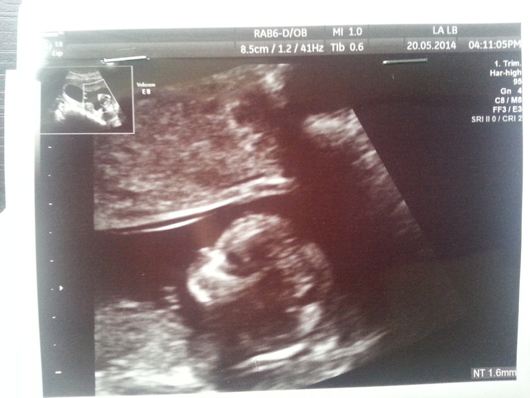 Наша долгожданная встреча / 1-ое УЗИ