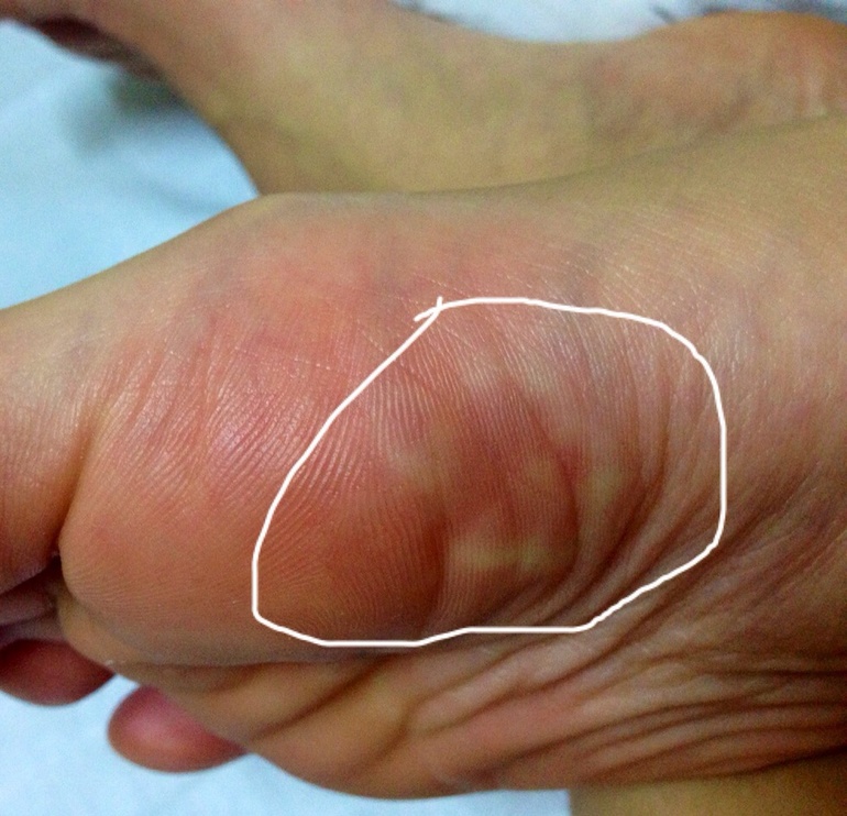 Варикозное расширение вен на ногах: симптомы и лечение