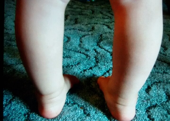 ребенок косолапит при ходьбе — 25 рекомендаций на Babyblog.ru