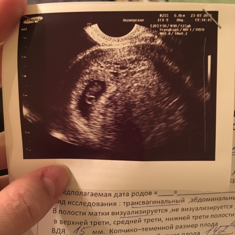 Неделя от зачатия форум. УЗИ В 6 недель беременности УЗИ. Снимок УЗИ на 6 неделе беременности. УЗИ 7 недель беременности УЗИ. УЗИ 6 недель беременности гипертонус.