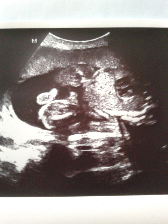 Узи 25 недель беременности фото мальчик