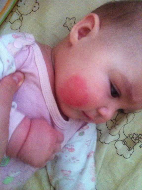 Пятно на щеке(