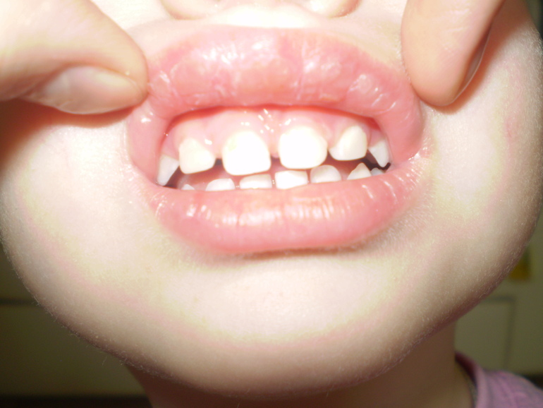 Мы вылечили зубки!