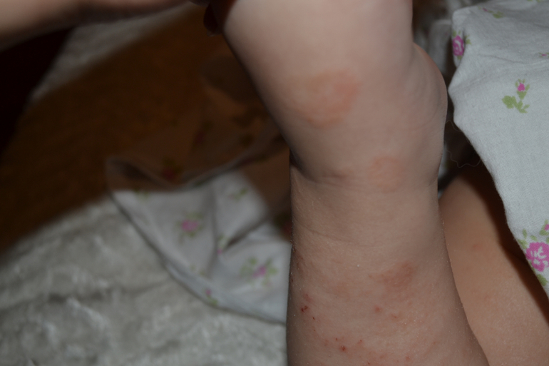 Атопический дерматит, или что то другое???