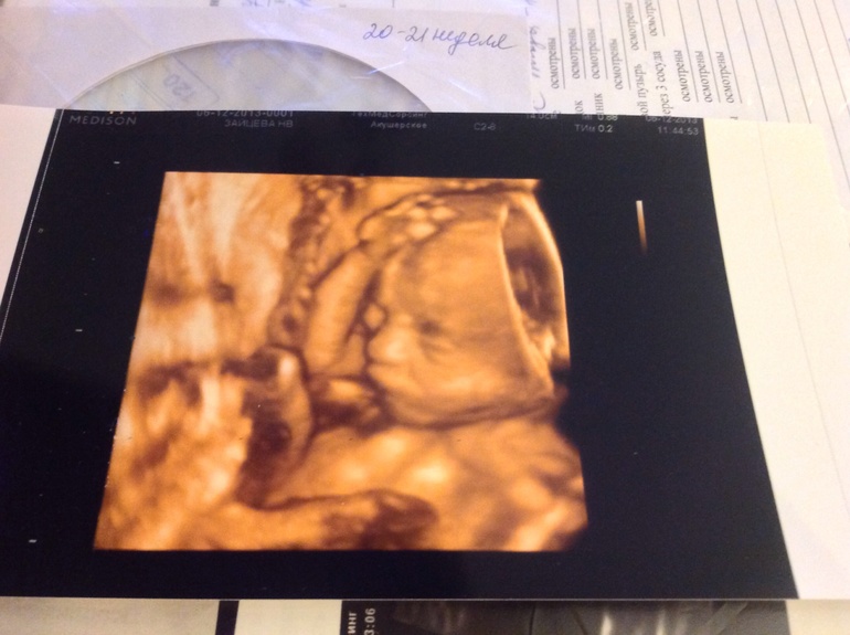 Узи 20-21 неделя