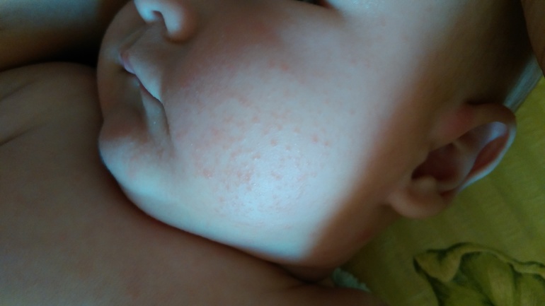 Есть аллергия на гречку. Аллергия на порошок у ребенка. Аллергия на порошок у новорожденного. Аллергия на порошок у ребенка сыпь.