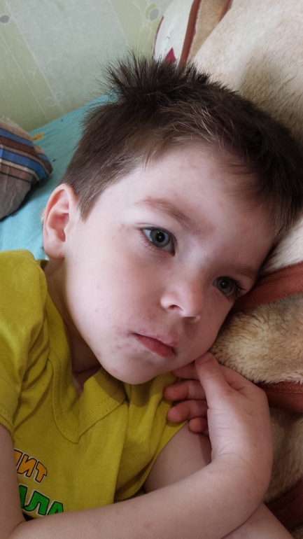 Повторная ветрянка((((((