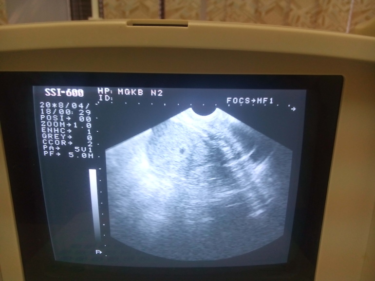 Узи 3 4 недели. Снимок УЗИ на 2 неделе беременности на мониторе. Снимок УЗИ на 4 неделе беременности на мониторе.