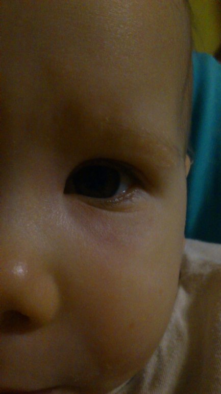 аллергия ли?