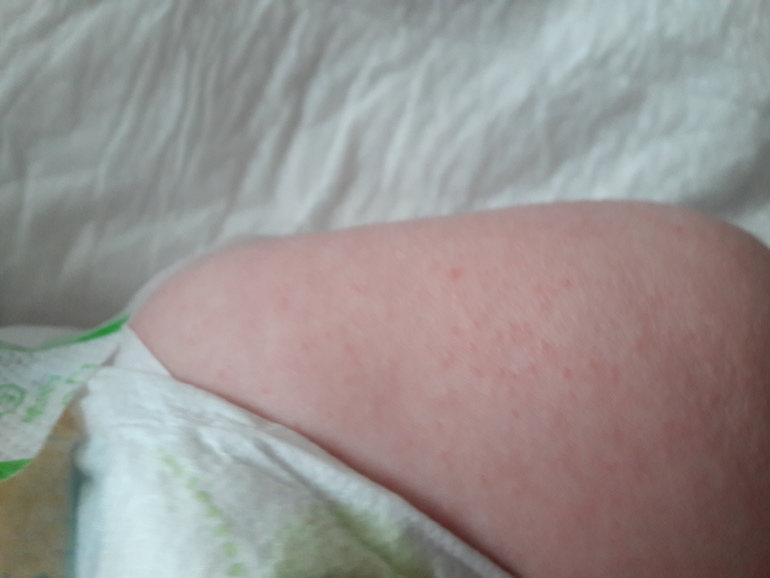 Аллергия на мучное у детей в год thumbnail