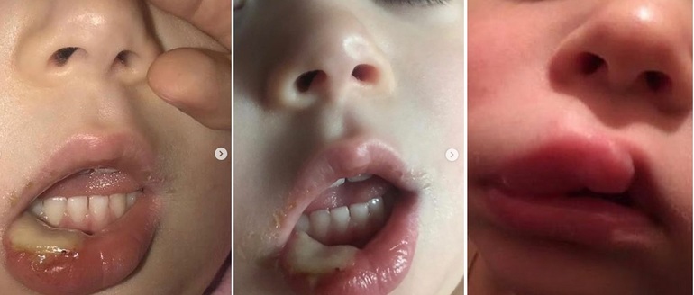 Покраснения на щеках ребенка возрастом 9 месяцев