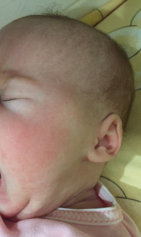 Румянец на щечках у малыша: когда необходимо обратиться к врачу
