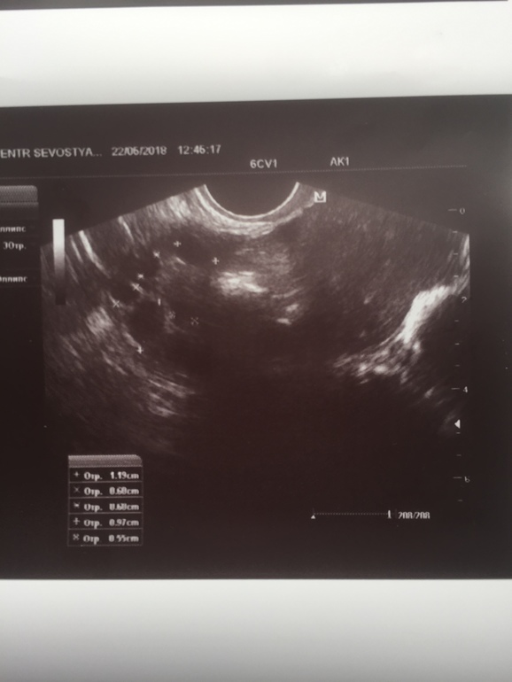 Доминантный фолликул на узи. 21 дц эндометрий 16 мм. Фолликулометрия узи доминантный фолликул. Фолликул 17 мм. Жёлтое тело в яичнике на узи.