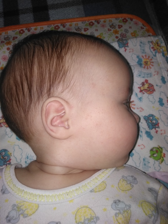 Кривой лоб. Долихоцефалическая форма головы новорожденного.