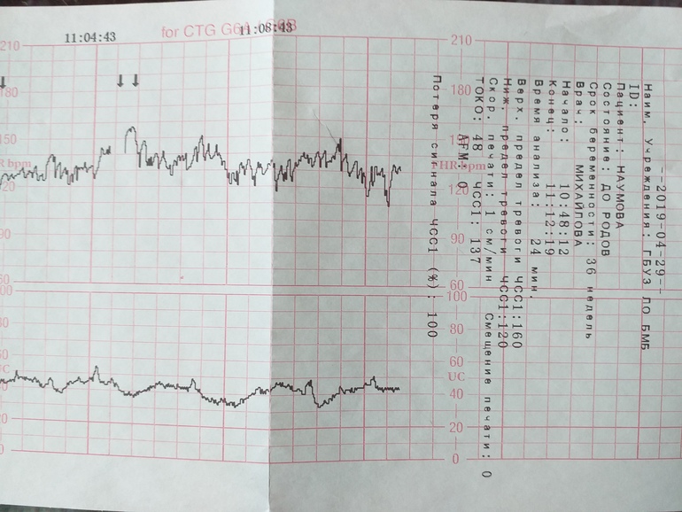 Ли ктг. КТГ 170-190. КТГ С отклонениями. Total scores при КТГ. КТГ двойни.