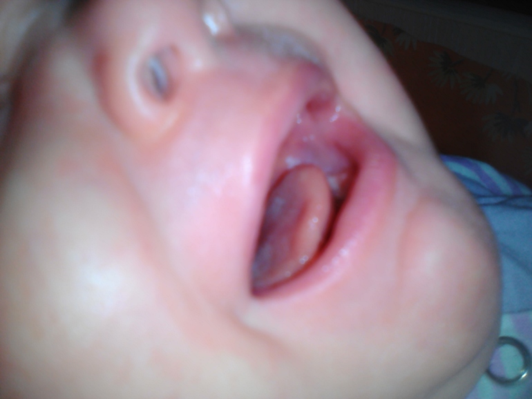 Кандидоз (молочница) полости рта у детей