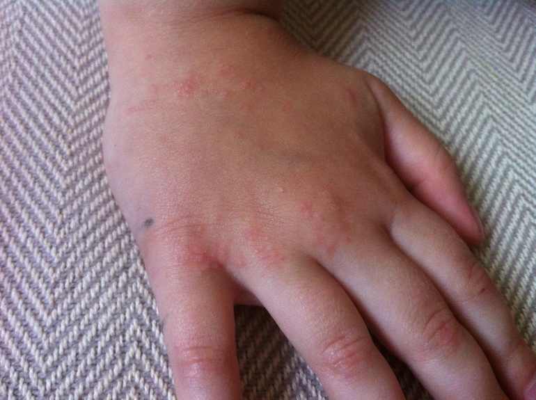 Сыпь на руках. Что это?